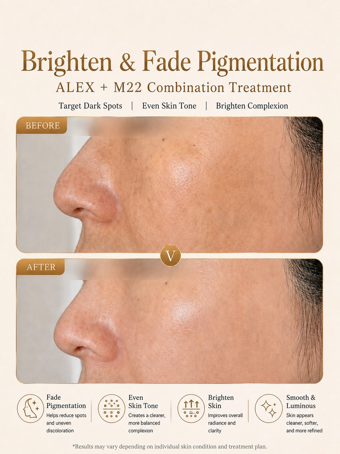 Supplied ALEX and M22 pigmentation before-and-after result
