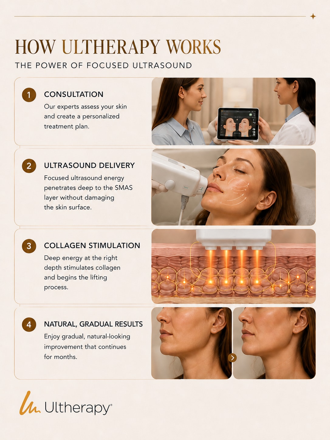 How Ultherapy focused ultrasound treatment works